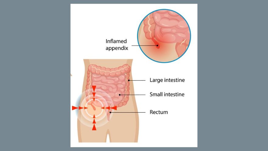 Understanding Appendicitis: Symptoms, Causes, Stages, and Treatment