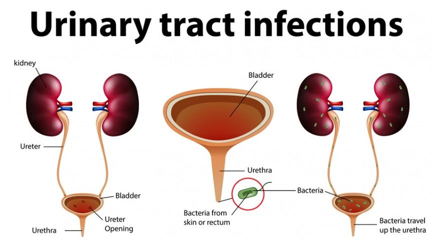 Urinary Tract Infections (UTIs): Causes, Symptoms, Prevention, and Treatment